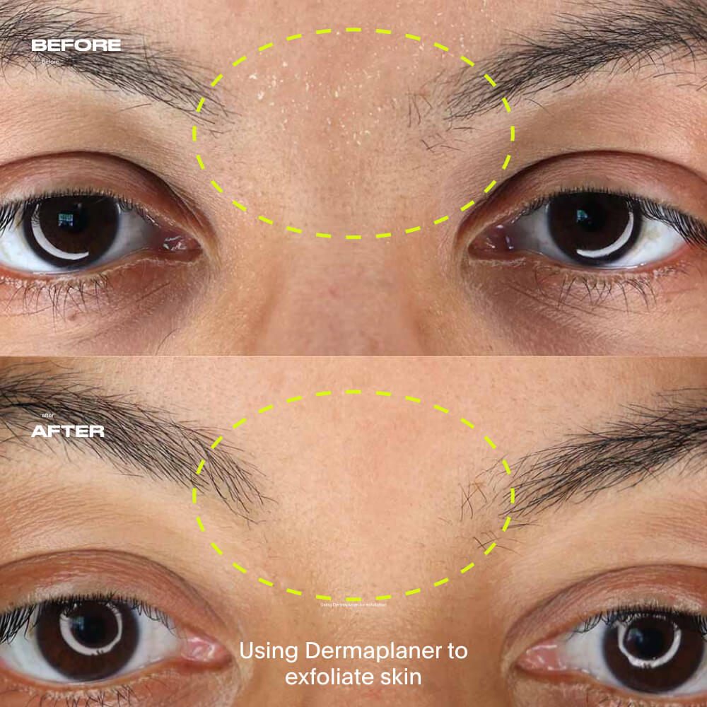 A before and after of the area between the eyebrows with the dermaplaner